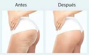 🔬 Carboxiterapia y Optimización del Tejido Cutáneo: Un Enfoque Científico para la Medicina Estética Avanzada