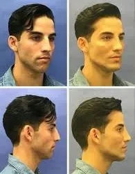 Rinomodelación no quirúrgica: ciencia, control y precisión en la estética facial avanzada