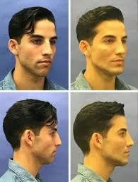 Rinomodelación no quirúrgica ciencia, control y precisión en la estética facial avanzada